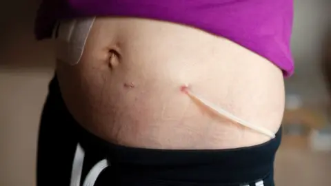 Getty Images Catheter for peritoneal dialysis