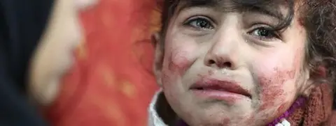 AMER ALMOHIBANY Child in Eastern Ghouta